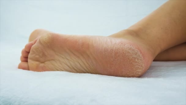 Dry Skin Female Feet Selective Focus People — Stock Video