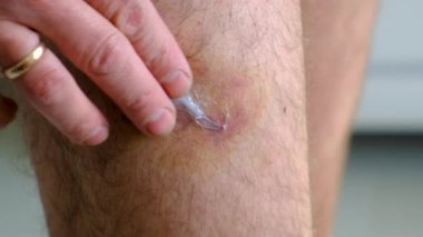Bacağında krem sürmesi için çürük var. Seçici odaklanma. insanlar.