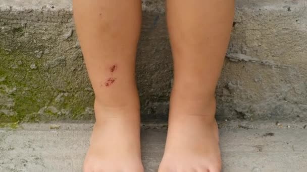 Child Has Bruises His Legs Selective Focus Kid — Stock Video