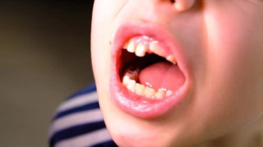 Çocuğun kötü dişleri var. Seçici odaklanma. çocuk.