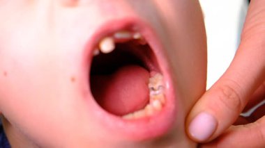 Çocuğun kötü dişleri var. Seçici odaklanma. çocuk.