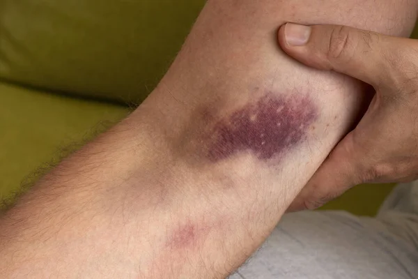 Tangan Pria Dengan Hematoma Besar Konsekuensi Injeksi Stok Gambar