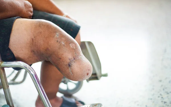膝の切断患者が車椅子に座り — ストック写真