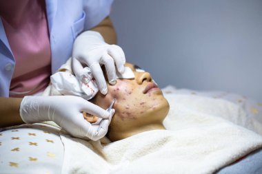 Yüzdeki sivilce sorunu deri iltihabı. Kadınlardaki güzellik kavramı. Deri bozuklukları kadınlarda depresyona ve güvensizliğe yol açar.