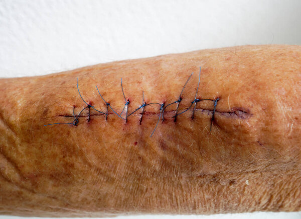 melanoma mole removed from the forearm of a women. White background