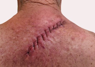 Bu yakın plan görüntüde taze bir cerrahi yara izi, bir adamın sırtındaki melanomun çıkarılması, iyileşme sürecini ve bir ameliyattan sonra iyileşme sürecini vurguluyor..