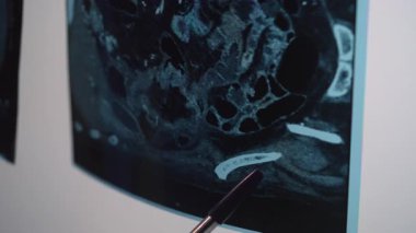 Doktor röntgen görüntülerindeki bağırsakların ve diğer iç organların bir monitöre bağlı olduğunu belirtiyor..