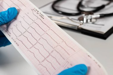 Hastanın yanında oturan hastanın ellerinin kardiyogramın sonucunu tutuyor. Kardiyovasküler sistem kavramının incelenmesi.