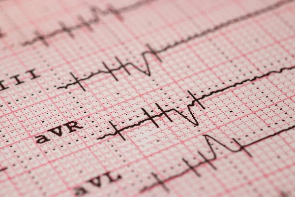 Close up of an electrocardiogram in paper form