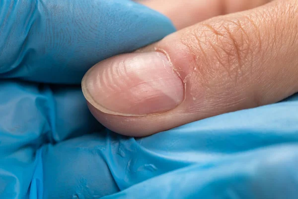 Doctor in gloves examining a ridged fingernails with vertical and horizontal ridges. Nails problems.