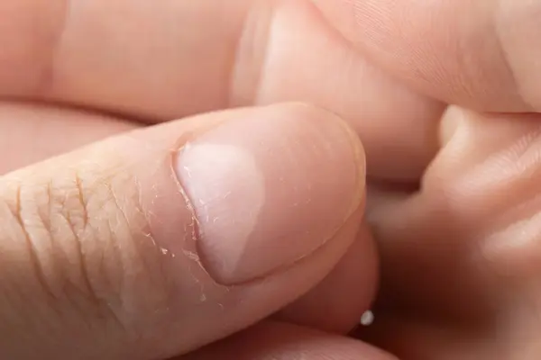 Gesägte Fingernägel Mit Vertikalen Und Horizontalen Graten Nagelprobleme lizenzfreie Stockfotos