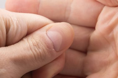 Ridged fingernail of a thumb finger of a man with horizontal ridges. clipart