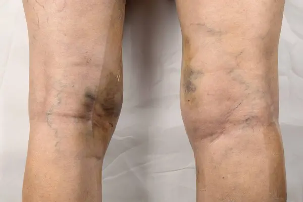 Woman legs after varicose vein surgery, with visible surgical sutures stitches and wounds on a leg. Curative treatment, aesthetic procedures, thrombosis prevention and senior health care concept.