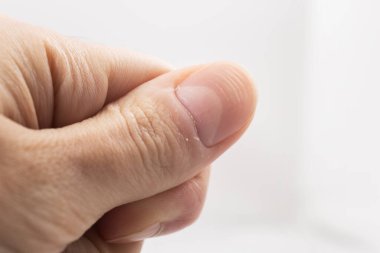 Beyaz arka planda yatay çıkıntıları olan bir adamın başparmağının tırnağı.