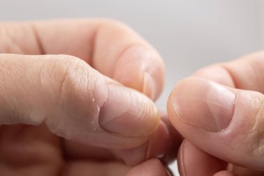 Ridged fingernail of a thumb finger of a man with horizontal ridges on white background clipart