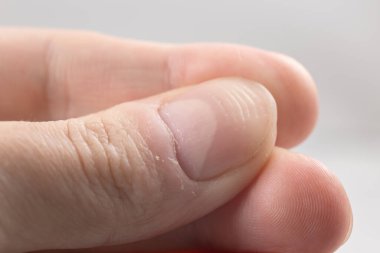 Beyaz arka planda yatay çıkıntıları olan bir adamın başparmağının tırnağı.
