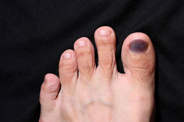 Picture of all five toes of the left toe. There is a bruise on the big toe nail from the injury.