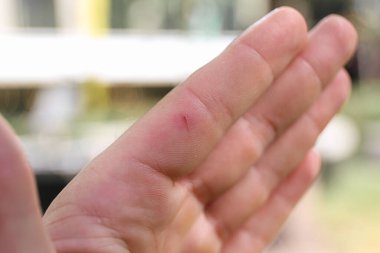 Parmağındaki kesiği kapat.