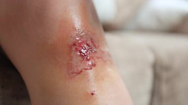 Diz yarası, el, yeni bir diz yarasını deride pamukla temizliyor, yara bakımını temsil ediyor, ilk yardım, ve kişisel sağlık, yakın çekim.