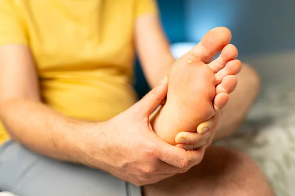 Siğil otu, ayak üstü fasitis siğil. Yaya derisi üzerinde HPV virüsü