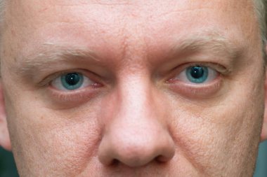 Göz bebekleri büyümüş bir adamın göz kapağı. Göz doktoru retinayı incelemek için göz bebeklerini büyüttükten sonra.