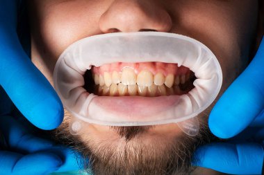 Ağız genişletici, ağız tutucu dudaklı, dişçi koltuğunda oturan bir adam.