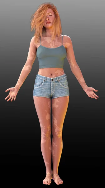 Rood Hoofd Vrouw Met Vitiligo Dragen Van Een Zomer Outfit — Stockfoto