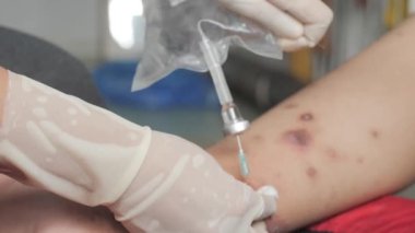 El temizliği yapan hemşirenin ayağını iltihap dolu ülserle kapat. Uyuz enfeksiyonundan, hassas cilt kaşıntısından kaynaklanıyor.