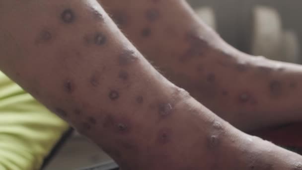 Ayaklarını Kapat Iltihap Dolu Ülser Uyuz Enfeksiyonu Hassas Cilt Kaşıntısı — Stok video