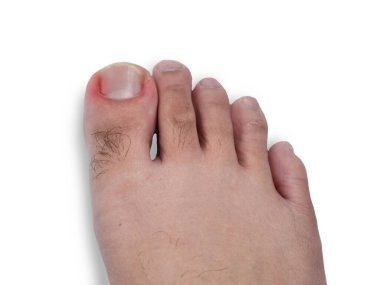 Ayak tırnağındaki sorun ile ayağını kapat, üst görünüm beyazda izole edilmiş.