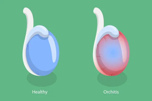 Isometric Flat Vector Conceptual Illustration Orchitis Inflammation Testes — 스톡 벡터