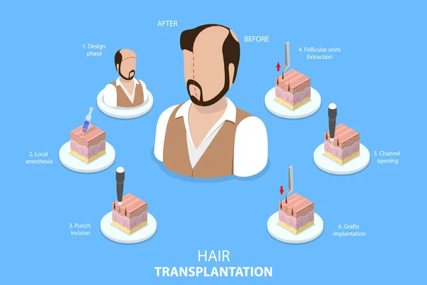 Isometric Flat Vector Conceptual Illustration Hair Transplantation Stages Fue Procedure — Archivo Imágenes Vectoriales