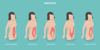 3 Boyutlu Isometric Düz Vektör Abdominal Kas Diastazının Kavramsal İllüstrasyonu, Hamilelikten Sonra Kadınlar Probmlem