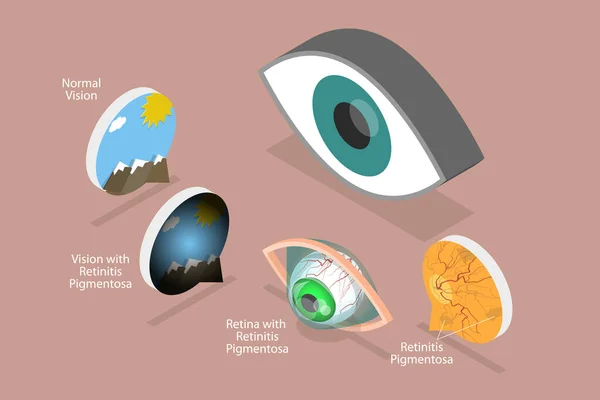 Ισομετρική Επίπεδη Διανυσματική Εννοιολογική Απεικόνιση Της Εκφυλιστικής Όρασης Του Αμφιβληστροειδούς — Διανυσματικό Αρχείο