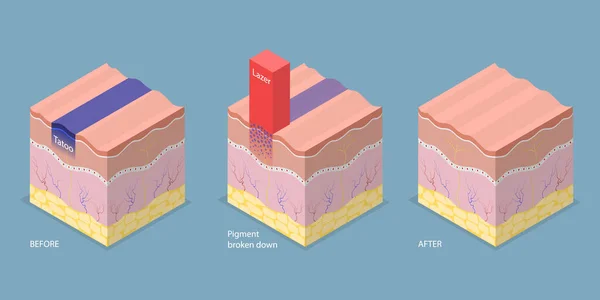 Isometrische Platte Vector Conceptuele Illustratie Van Lasertatoeage Verwijderen Cosmetische Dermatologie — Stockvector