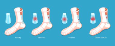 3B Isometric Düz Vektör Achilles Tendon 'un Kavramsal Resimleri, Tendinit Problemi