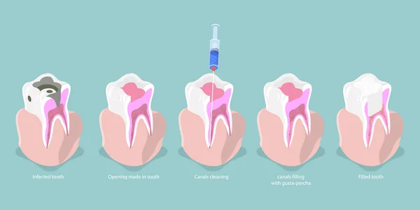 Isometryczny Płaski Wektor Konceptualny Ilustracja Próchnicy Zębów Wykres Leczenia Kanału — Wektor stockowy