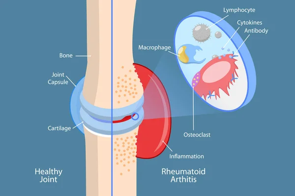 Ilustración Conceptual Vectores Planos Isométricos Artritis Reumatoide Dolor Óseo Lesión — Vector de stock