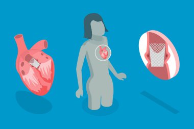 3D Isometric Düz Vektör Transcutaneous Aort Kapakçık Yenilemesi - TAVR, minimal İstilacı Cerrahi