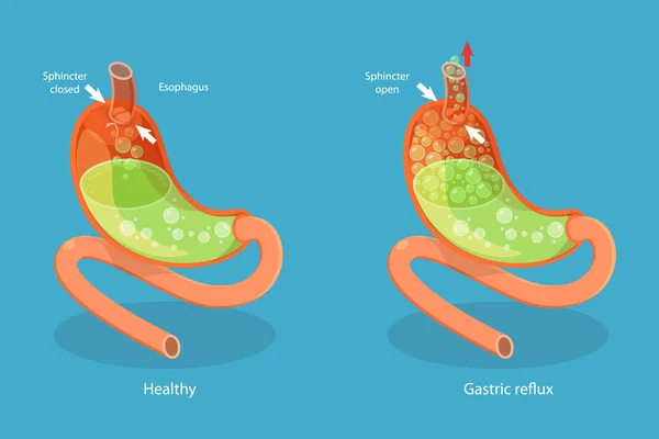 胃反流 消化系统问题的三维等距平面矢量概念图 — 图库矢量图片