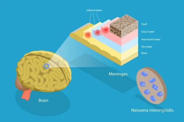 脑膜炎 人脑和脑膜炎球菌的三维等距平面载体概念说明 — 图库矢量图片