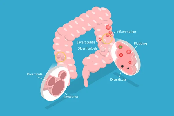 Isometric Flat Vector Conceptual Illustration Diverticulosis Diverticulitis Medical Structure Location — 스톡 벡터