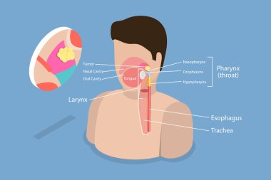 3 Boyutlu Isometric Düz Vektör Nasofaringeal Karsinom Tümörü, Eğitim Diyagramı