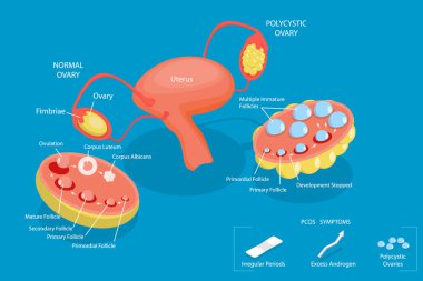 3D Isometric Düz Vektör Polycystic Yumurtalık Sendromu, PCOS