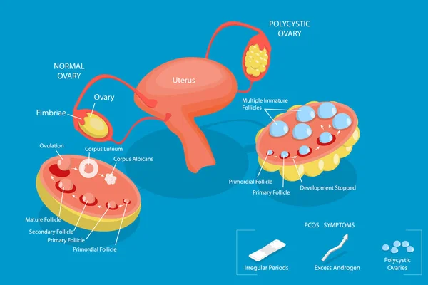 Ilustración Conceptual Vectores Planos Isométricos Del Síndrome Del Ovario Poliquístico — Vector de stock
