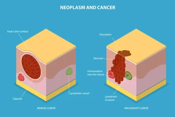 Illustration Conceptuelle Vecteur Plat Isométrique Tumeur Cancer Développement Tumeur — Image vectorielle