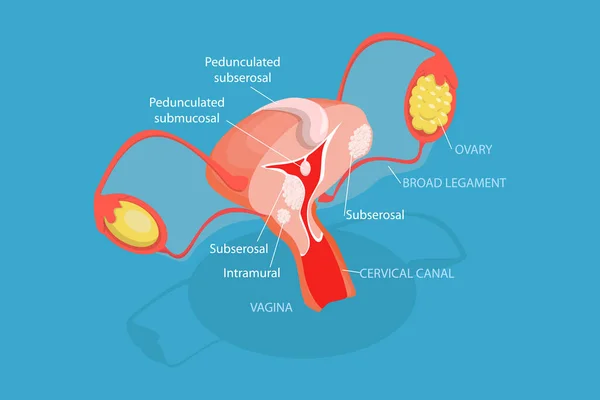 Ilustração Conceitual Vetor Plano Isométrico Dos Tipos Fibroides Uterinos Anatomia — Vetor de Stock