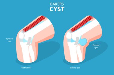 3D Isometric Flat Vector Conceptual Illustration of Bakers CYST, Traumatology and Prthopedics clipart