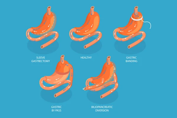 Ilustración Conceptual Vectores Planos Isométricos Tipos Cirugía Bariátrica Gastrectomía Manga — Archivo Imágenes Vectoriales