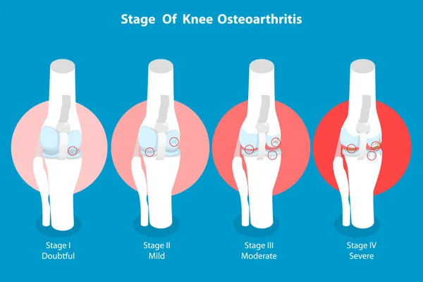3Dアイソメトリックフラットベクトル膝関節炎の病期の概念図 脚関節の解剖学 — ストックベクタ